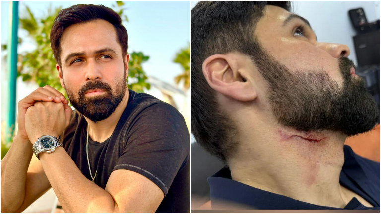 emraan hashmi, godachari 2, emraan hashmi injured